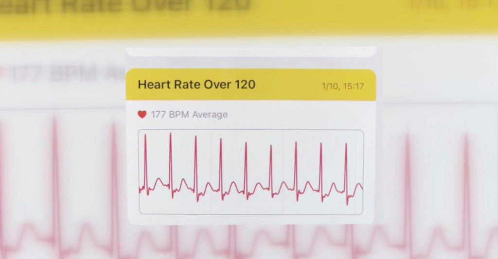Apple Watch Helps Woman Discover Supraventricular Tachycardia Heart Condition